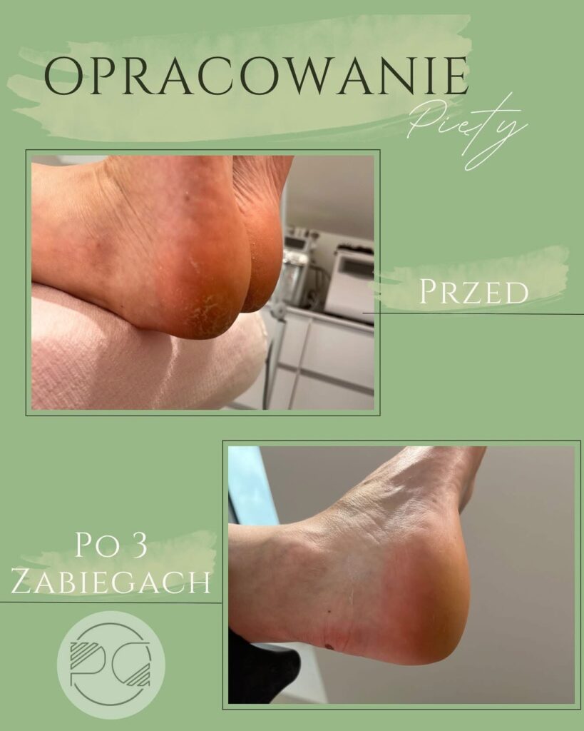 pedicure brzesko